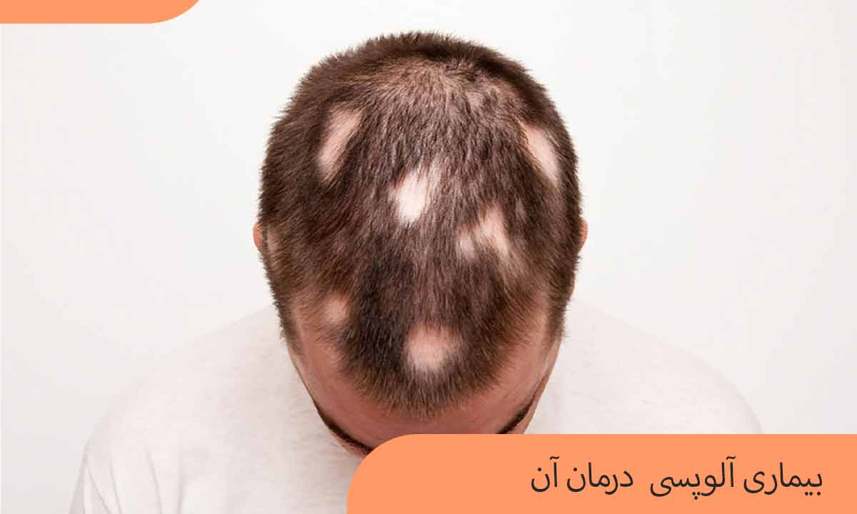 آلوپسی