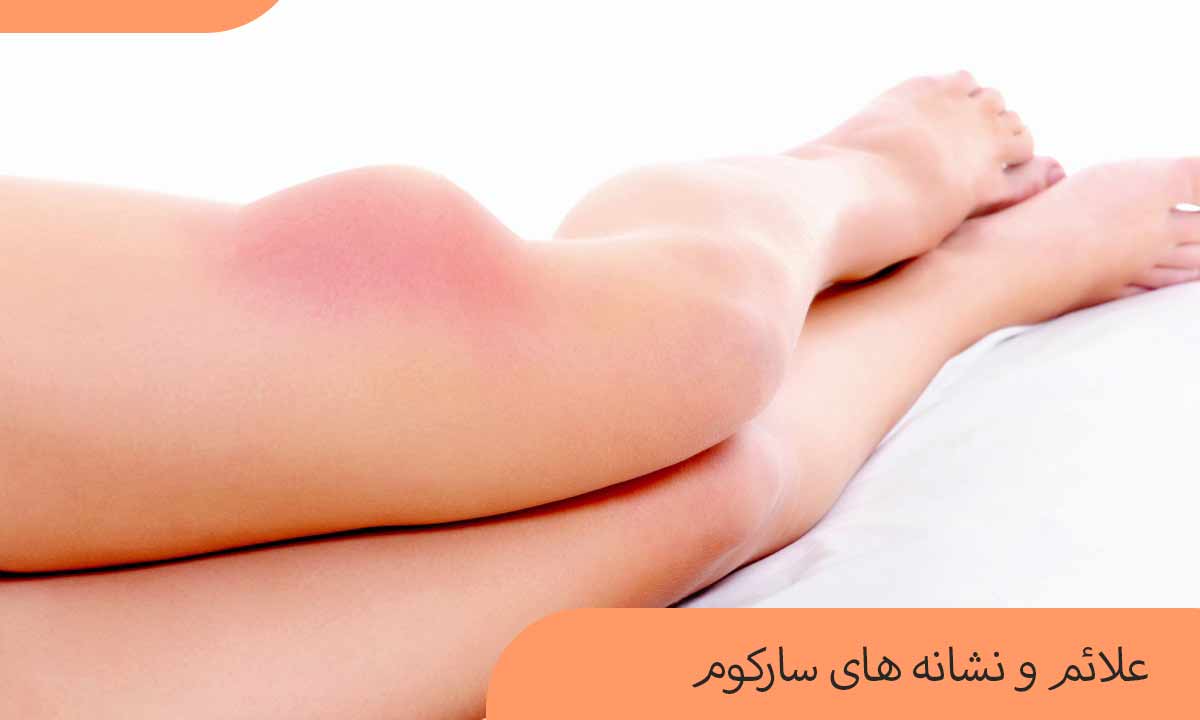 سارکوم