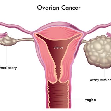سرطان تخمدان - نشانه های و روش تشخیص سرطان تخمدان - درمان سرطان تخمدان