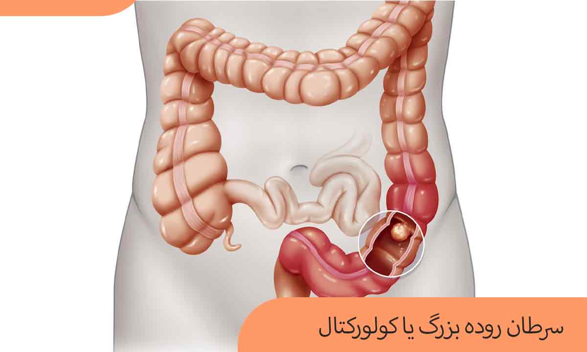 سرطان روده بزرگ یا کولورکتال