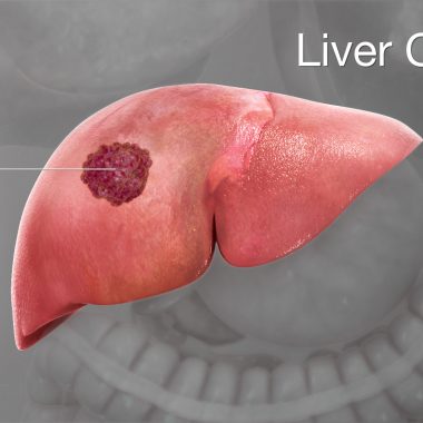 روش های شیمی درمانی سرطان کبد و اثربخشی آن برای بیماران