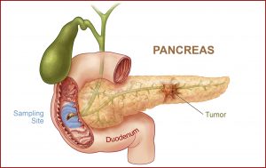 آشنایی با روش های درمان سرطان پانکراس بر اساس میزان پیشرفت