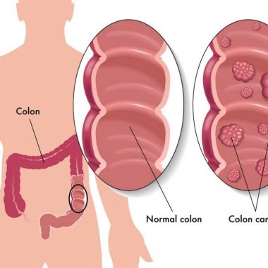 روش های تشخیص انواع سرطان روده بزرگ و درمان آنها