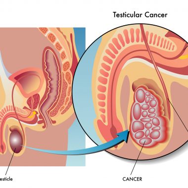 سرطان بیضه ، علل ، ریسک فاکتورها و راههای پیشگیری