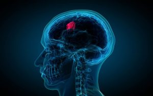 سرطان مغز چیست و از علائم و روش های درمانی آنچه می دانید؟