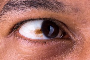 سرطان چشم چیست و چه علائم و ریسک فاکتورهایی دارد؟