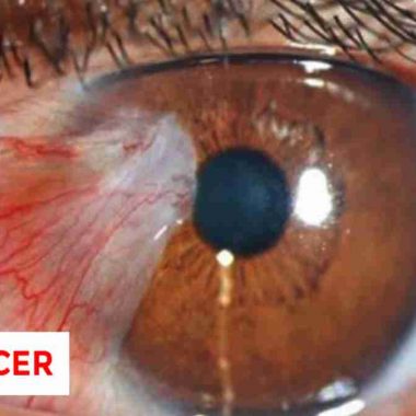 سرطان چشم چیست و چه علائم و ریسک فاکتورهایی دارد؟