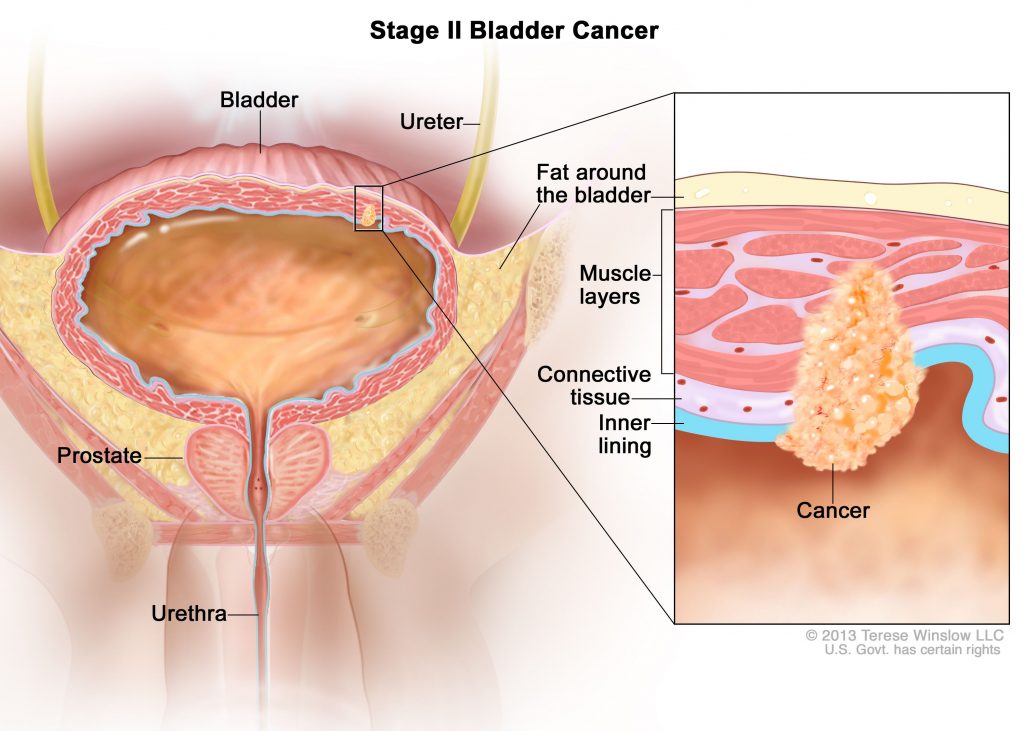 سرطان مثانه چیست و از ریسک فاکتورهای آن چه می دانید؟