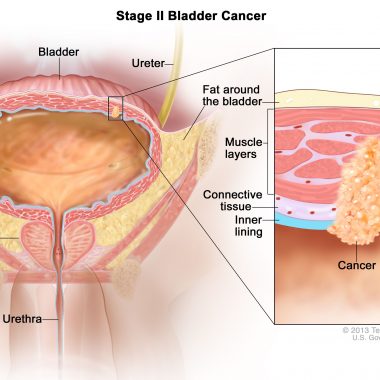 سرطان مثانه چیست و از ریسک فاکتورهای آن چه می دانید؟