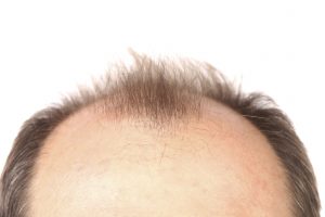 آشنایی با درمان های خانگی ریزش مو برای جلوگیری از ریزش مو