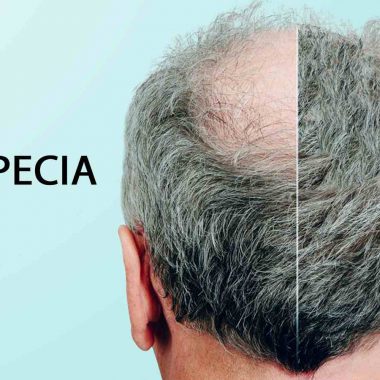 اهمیت و مزایای استفاده از داروی ماینوکسیدیل برای ریزش موی مردانه