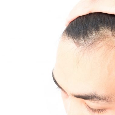 علت ریزش مو در مردان چیست و با چه علائمی خود را نشان می دهد؟