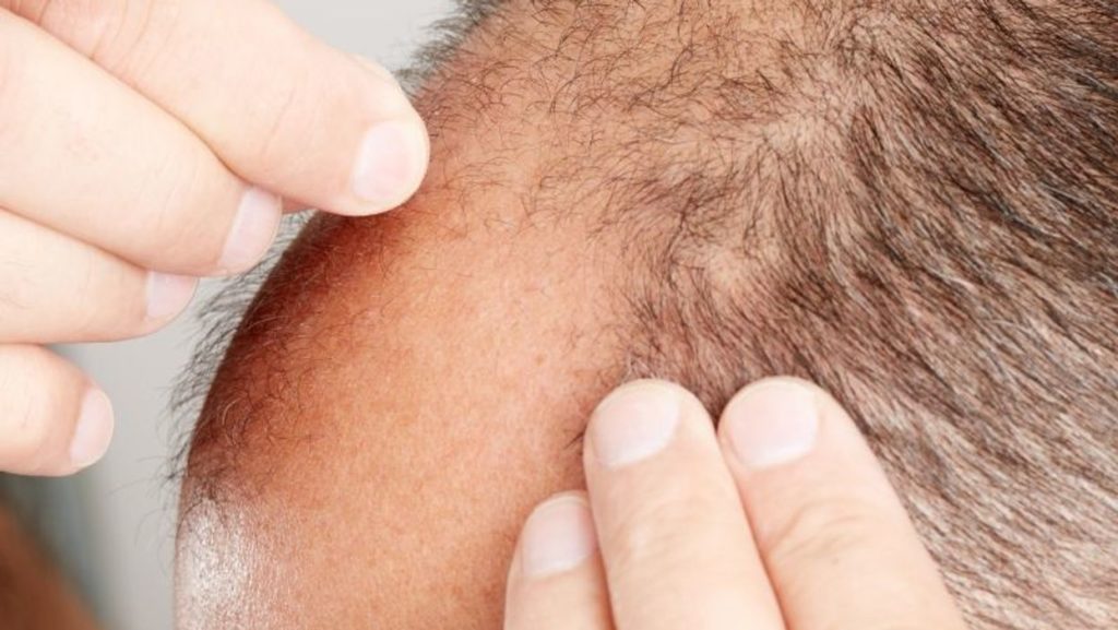 تاثیرات مثبت و مکانیسم اثر فیناستراید بر جلوگیری از ریزش مو