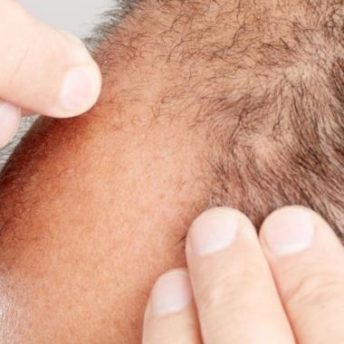 تاثیرات مثبت و مکانیسم اثر فیناستراید بر جلوگیری از ریزش مو