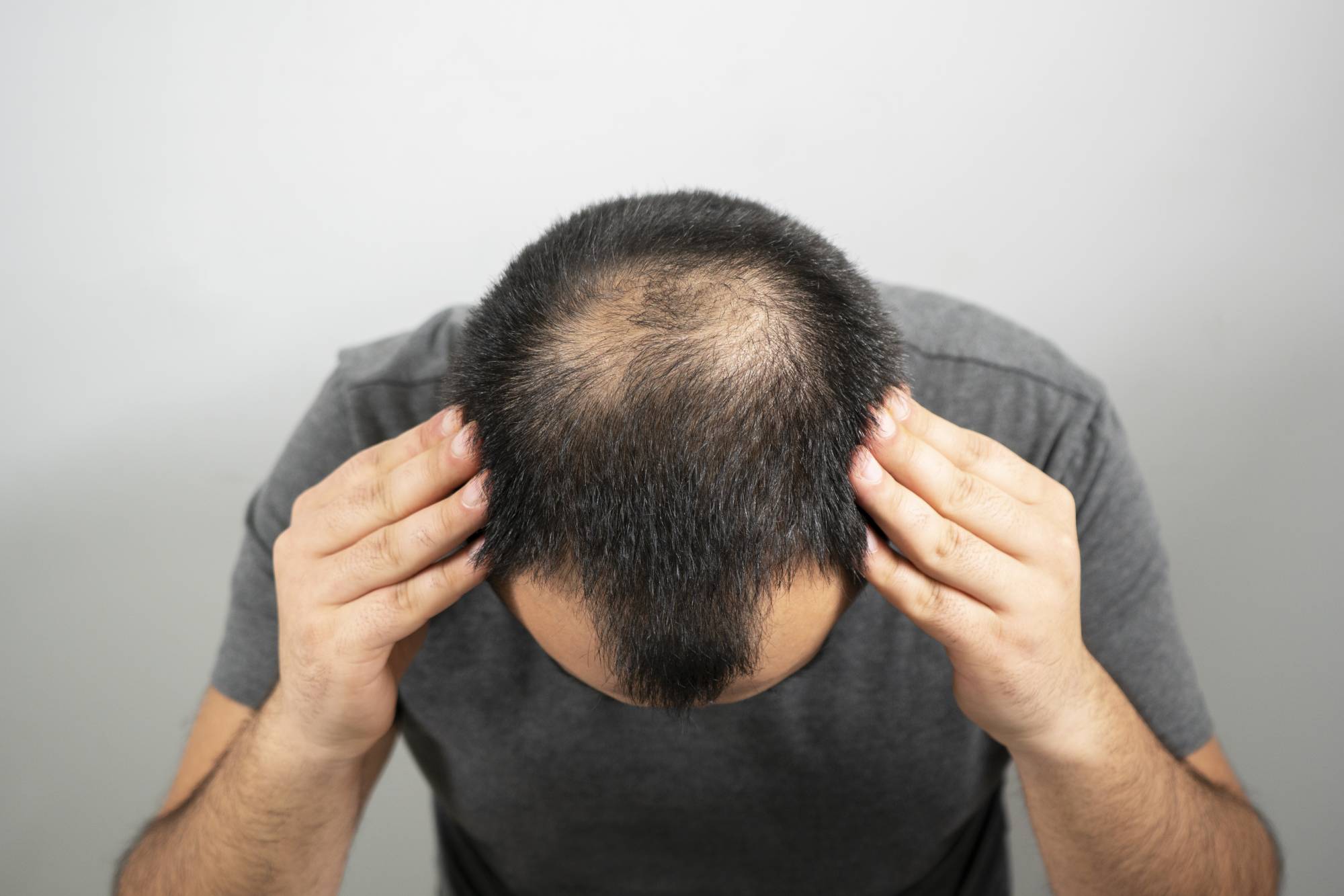 آشنایی با روش های جلوگیری و درمان ریزش موی مردانه