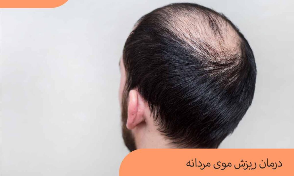 درمان ریزش موی مردانه