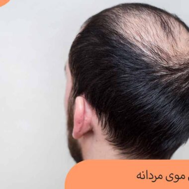 درمان ریزش موی مردانه