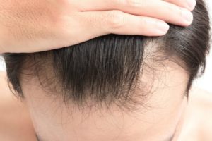آشنایی با روش های بسیار موثر در پیشگیری از ریزش مو 
