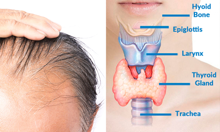 تاثیر کم کاری تیروئید بر ریزش مو و روش های جلوگیری از آن