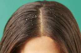 آیا شوره سر باعث ریزش مو می شود و چگونه می توان شوره سر را درمان کرد؟