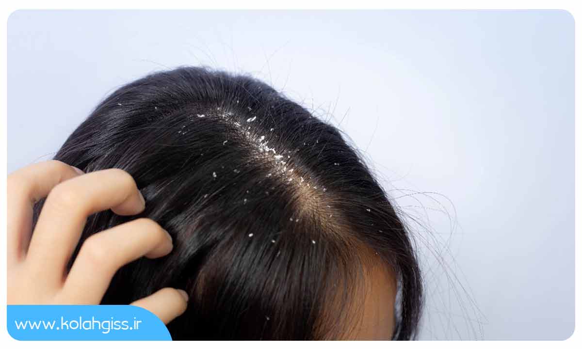 آیا شوره سر باعث ریزش مو می شود و چگونه می توان شوره سر را درمان کرد؟