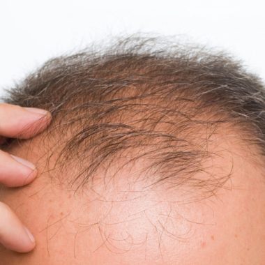 آیا اختلالات گوارشی می تواند باعث نازک شدن مو یا ریزش مو شود؟