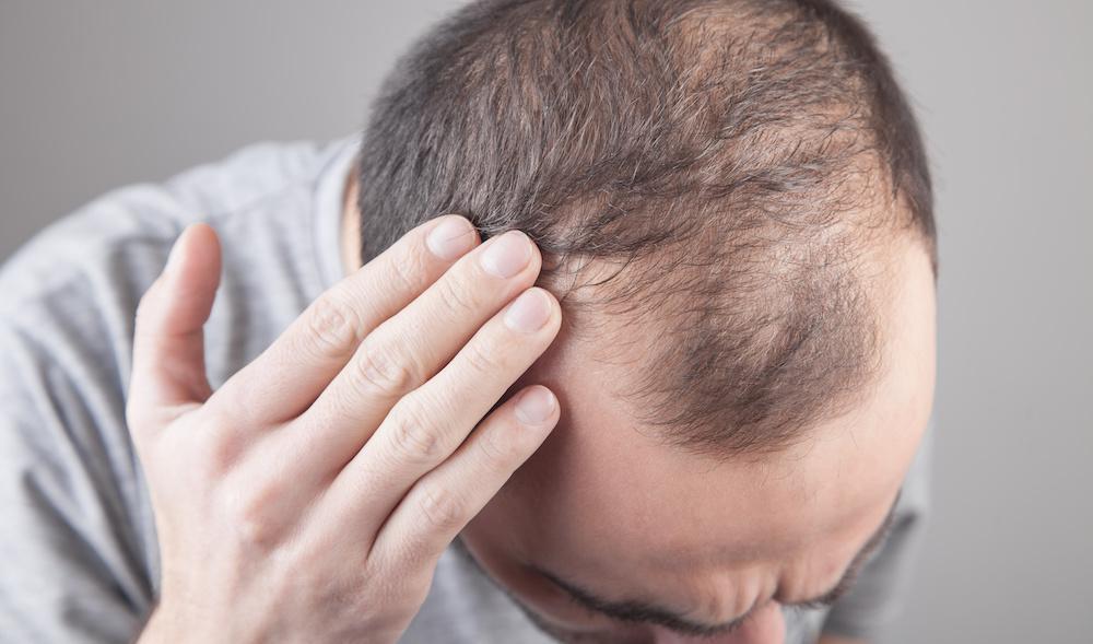 علت ریزش موی ناگهانی چیست و چگونه می توان از آن جلوگیری کرد؟
