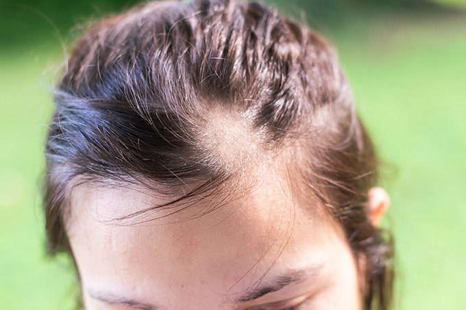 تریکوتیلومانیا یا اختلال کندن موی وسواسی چیست و چگونه درمان می شود؟