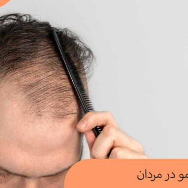 نازک شدن مو در مردان
