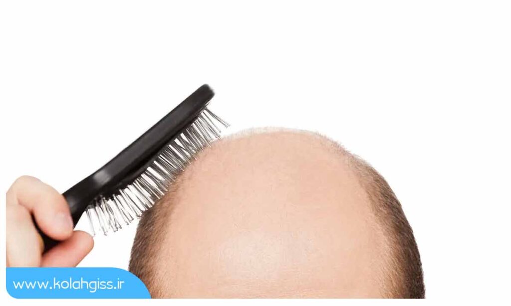 بیماری آلوپسی و استفاده از کلاه گیس با موی طبیعی