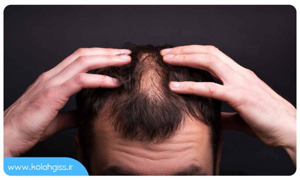 روش های درمان و پیشگیری از ریزش موی مردانه