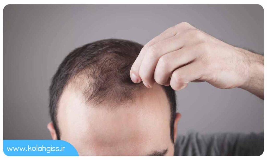 علت ریزش موی مردانه