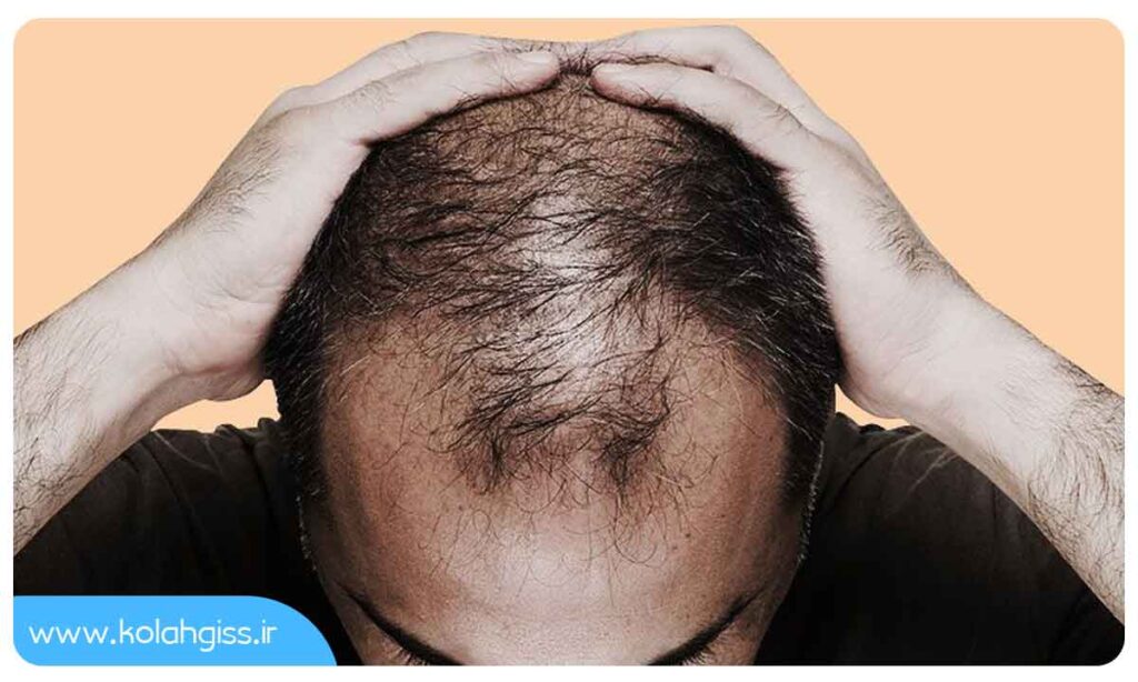 مهمترین علت ریزش مو در مردان