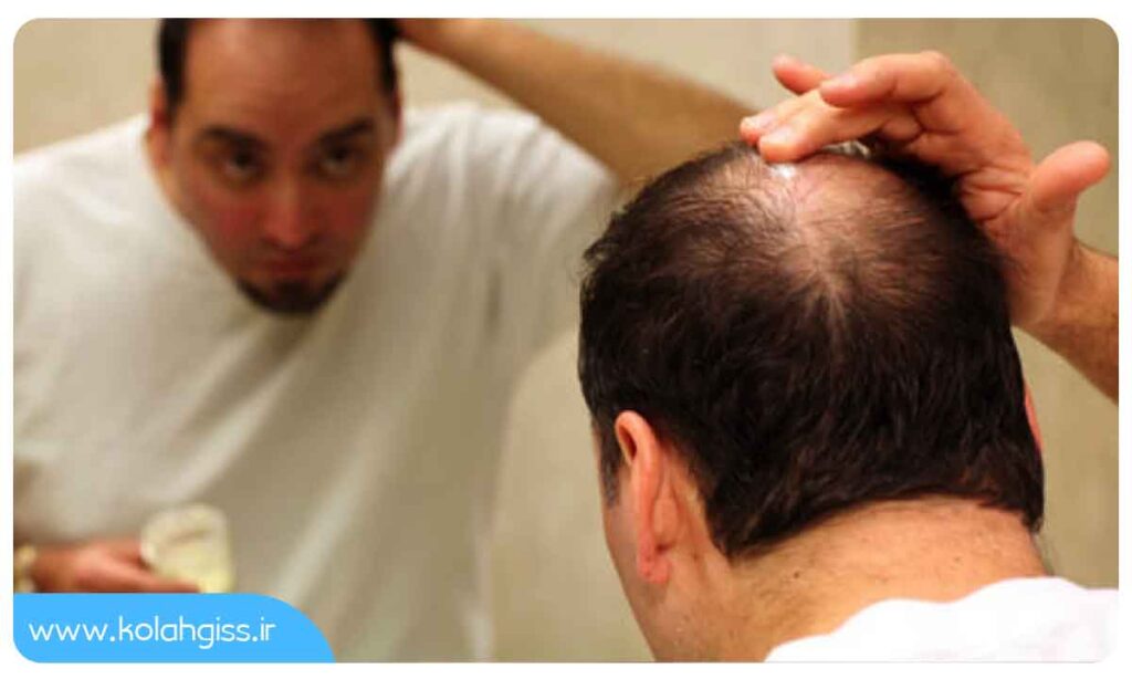درمان ریزش موی ناگهانی و شدید