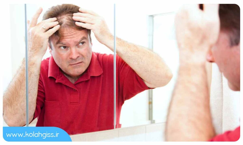 ریزش موی ناشی از استرس چقدر طول می کشد؟