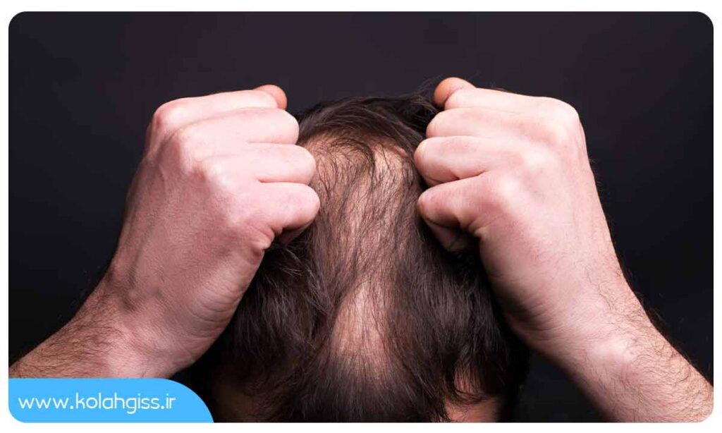 چگونه اضطراب و استرس باعث ریزش مو می شود؟