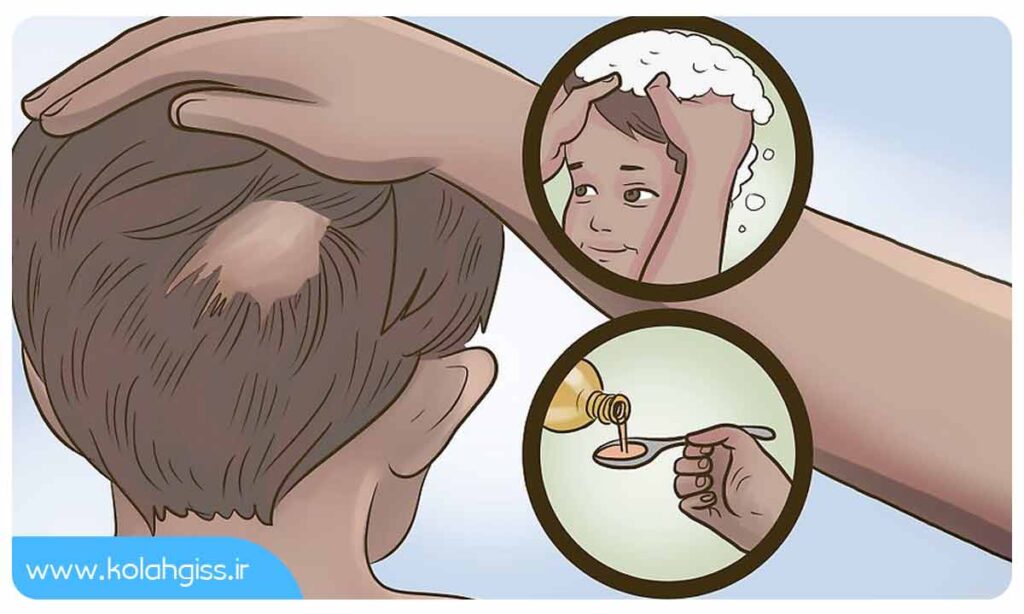درمان ریزش مو در کودکان