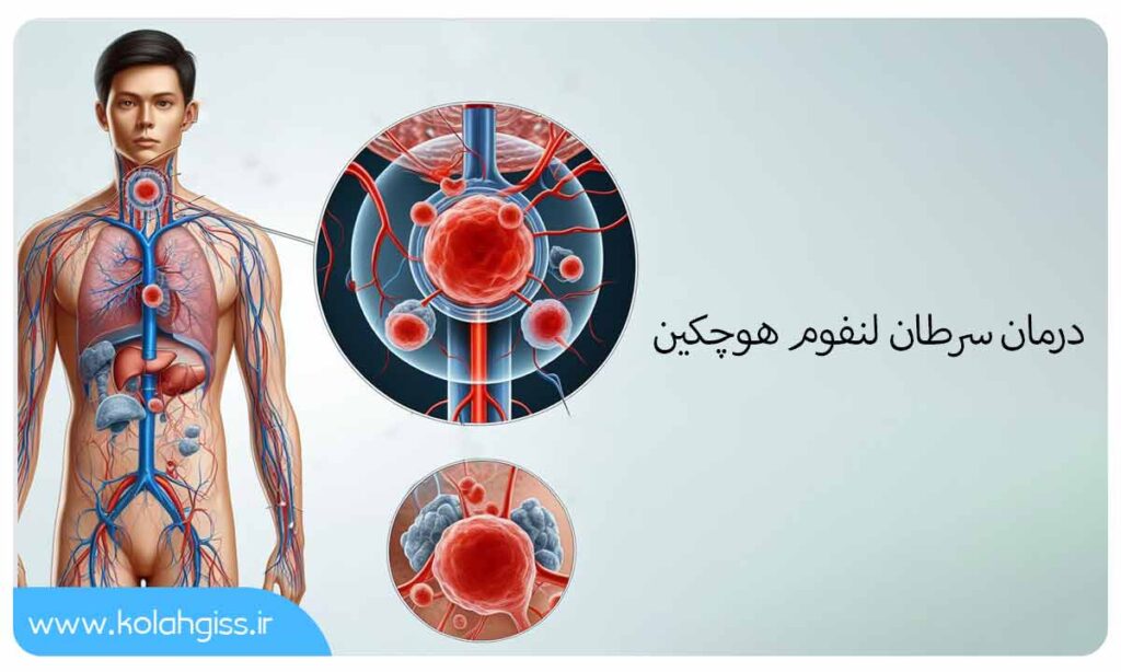 درمان سرطان لنفوم هوچکین