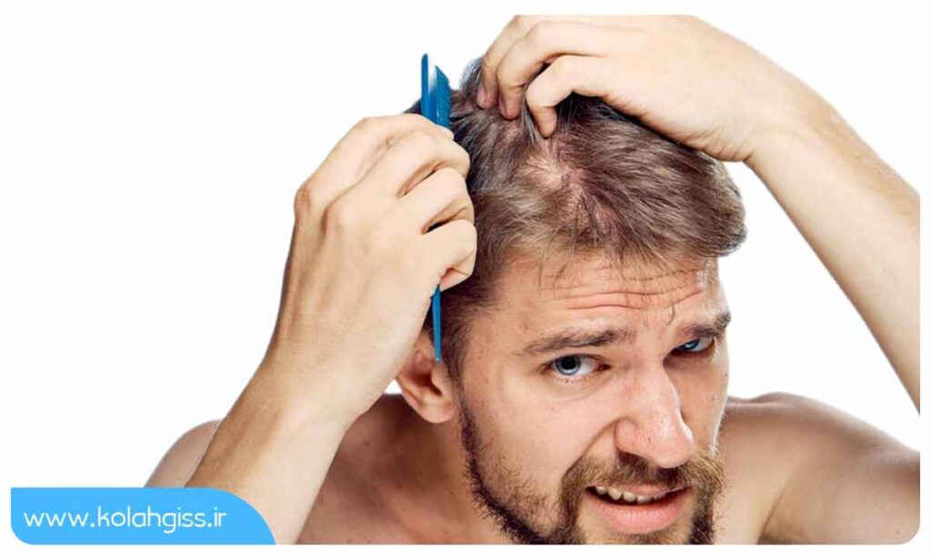 دلایل اصلی نازک شدن مو در مردان