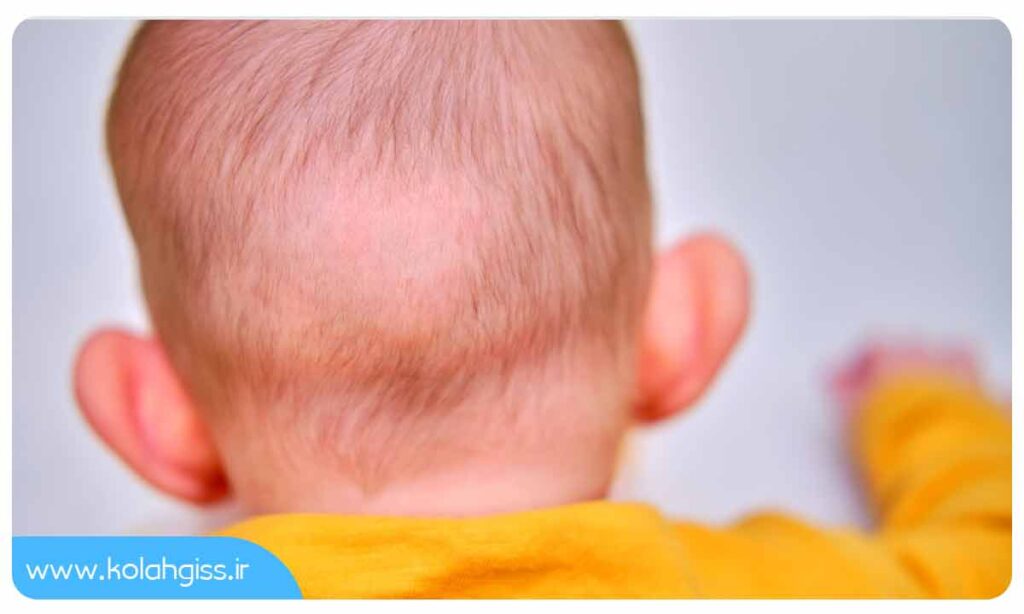 ریزش مو در کودکان چقدر طبیعی است؟