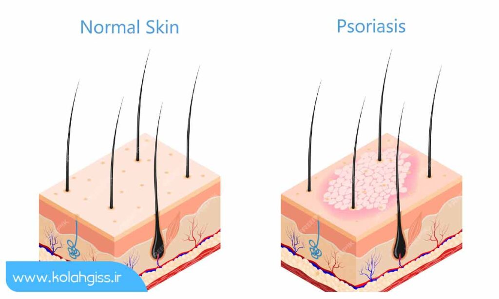 درمان پسوریازیس پوست سر